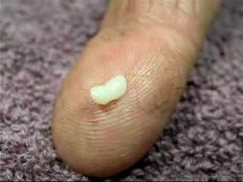 The four most common are roundworms, hookworms, tapeworms, and heartworms. Tapeworm segment - YouTube