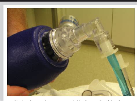 Figure 1 From The Esophageal Tracheal Double Lumen Airway Rescue For