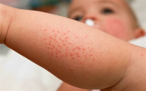 14 Newborn Rashes You Need To Know About And How To Treat Them