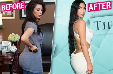 Kim Kardashian Gets Butt Implants Removed Claim Plastic Surgeons