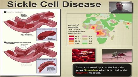 Chapter 14 Part 6 Sickle Cell Disease Youtube