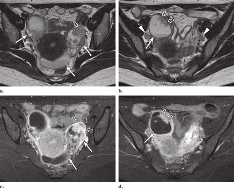 Bilateral Tubo Ovarian Abscesses And A Left Sided Pyosalpinx In A