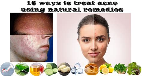 16 Ways To Treat Acne Using Natural Remedies Youtube