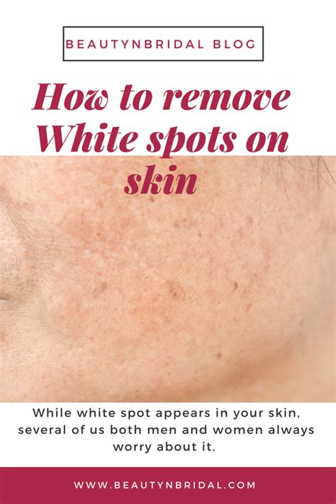 What Is Treatment For White Spot On Skin By Ayurveda Quora