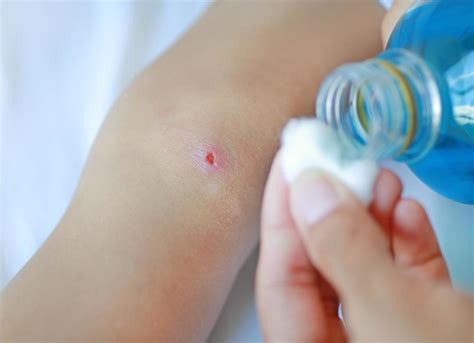 How To Treat Spider Bite Fast And Convenient Walk In Clinic La Jolla