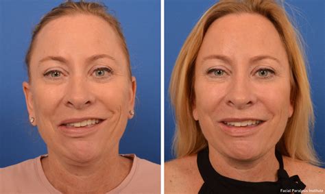 Most people make a full recovery within 9 months, but it. Bell's Palsy Facial Paralysis Treatment, Causes, Symptoms ...