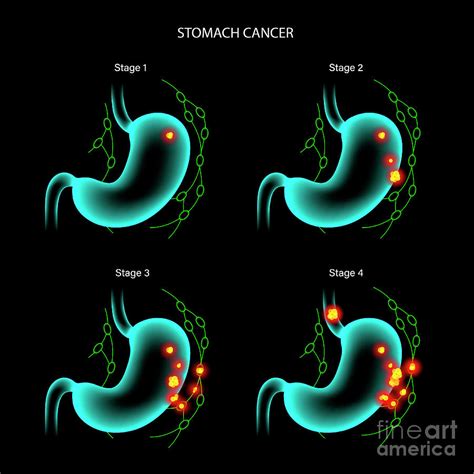 Stomach Cancer Photograph By Pikovit Science Photo Library Fine Art