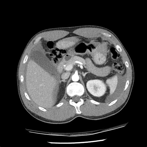 Liver Laceration Due To Knife Stabbing Radiology Case