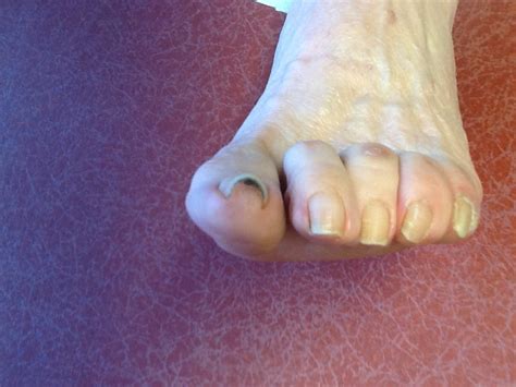 Foot And Ankle Problems By Dr Richard Blake Why Do Toenails Become