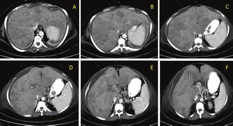 A F Portal Venous Phase Contrast Ct Scans Showing Hepatomegaly With