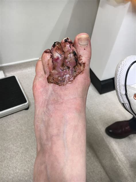Hammertoe Before And After Surgery Before And After