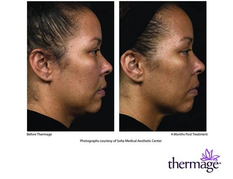Thermage Skin Tightening Treatment Charlotte Nc Med Spa