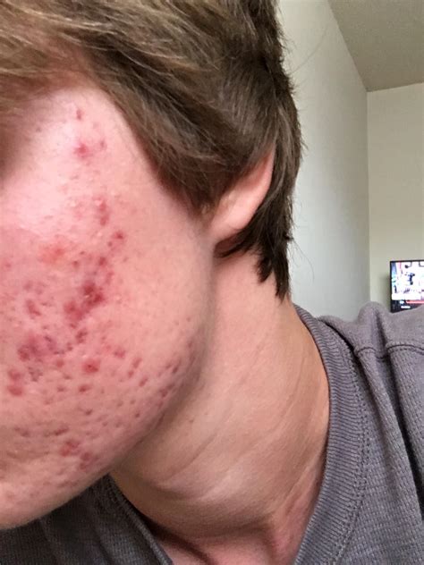 How Severe Is My Acne And What Can Be Done To Help It General Acne Discussion Forum