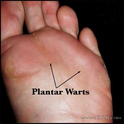 Plantar Warts | athletiek