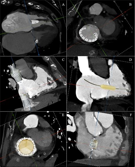 Frontiers Transcatheter Tricuspid Valve Therapy From Anatomy To