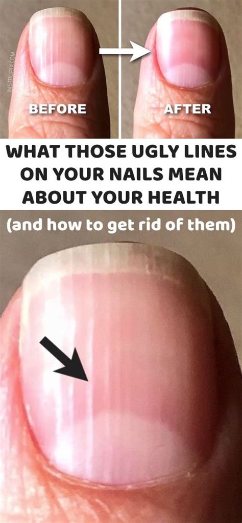 What Those Vertical Lines On Your Nails Mean About Your Health Nail