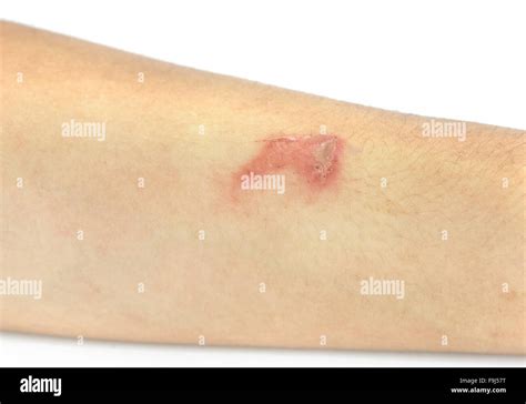 Raised Red Bumps And Blisters Caused By Shingles On Skin Stock Photo