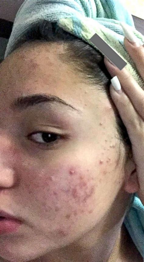 Teen Shares How She Cleared Her Severe Acne Using Cheap Products Abc News