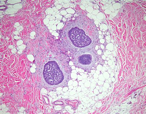 Pathology Outlines Polymorphous Sweat Gland Carcinoma