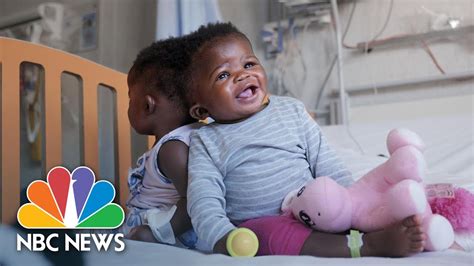 Twin Sisters Conjoined At The Head Successfully Separated By Surgery