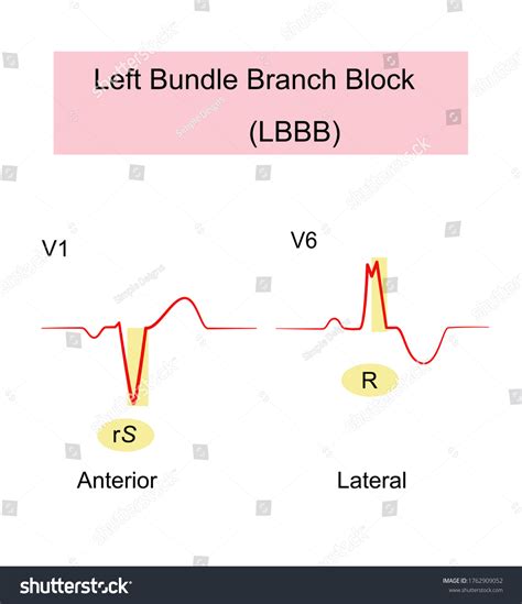Left Bundle Branch Block Lbbb Ecg Stockvektor Royaltyfri 1762909052