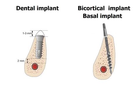 What Are Bicortical Dental Implants Or Basal Implants News Dentagama