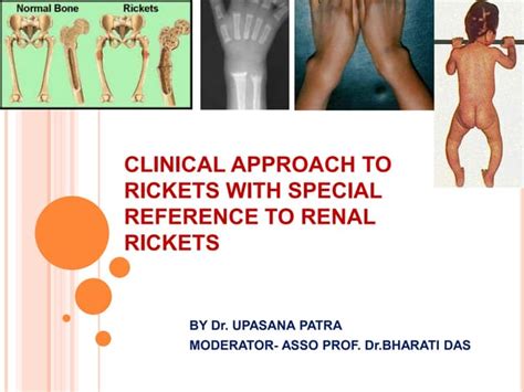 Clinical Approach To Rickets With Special Reference To Renal Rickets