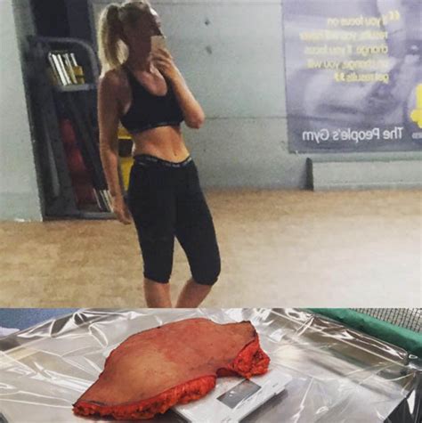 Plastic Surgery Tummy Tuck Picture Grosses Josie Gibson Fans Out