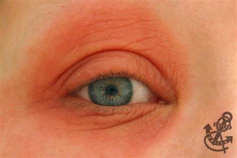 How To Treat Red Swollen Eyes From Allergies Heal Info
