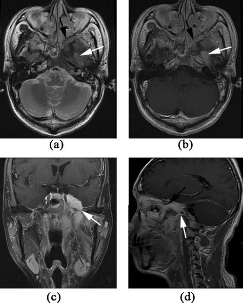 Magnetic Resonance Imaging Features Of Nasopharyngeal Carcinoma And