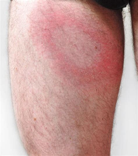 What Does A Lyme Disease Rash Look Like With Pictures