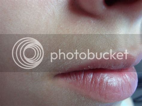 Electrolysis On The Upper Lip Professional Electrolysis Hairtell