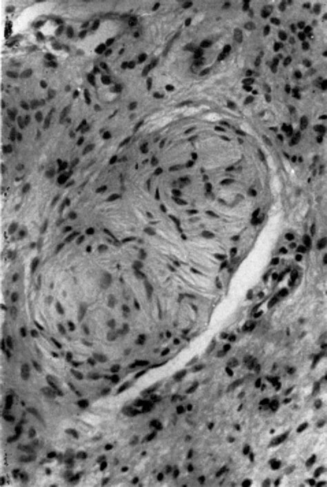 Figure 8 From Schüller Christians Disease Semantic Scholar