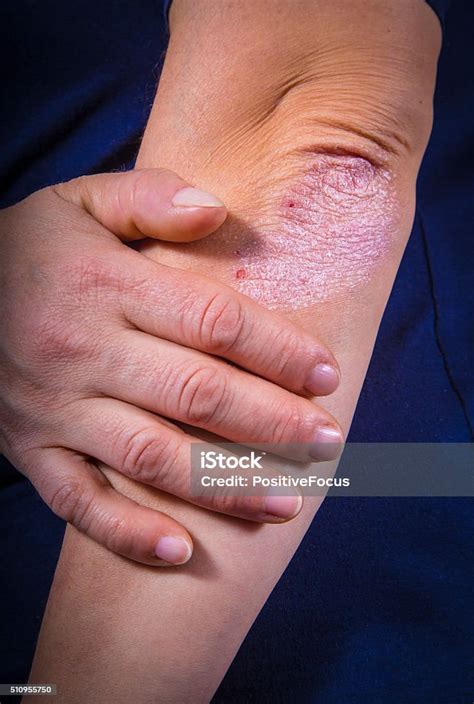 Psoriasis On Elbow Stock Photo Download Image Now Adult Body Care