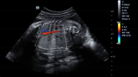 Congenital pulmonary airway malformation (cpam), previously known as congenital cystic adenomatoid malformation (ccam), is a rare developmental anomaly of the l. intralobar pulmonary sequestration usg antenatal - YouTube