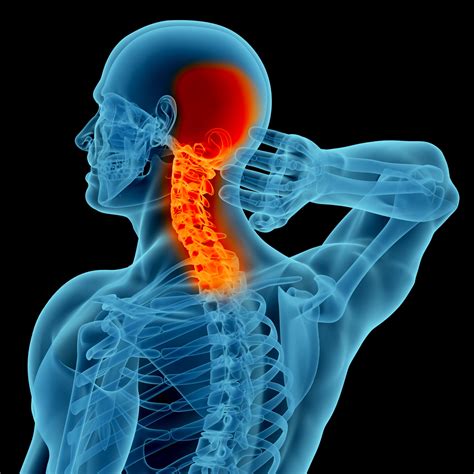 What Is Neck Pain Painscale