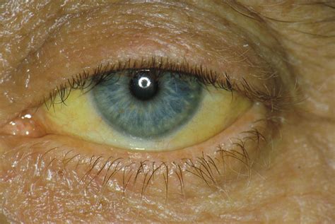 Jaundiced Eye Photograph By Dr Ma Ansaryscience Photo Library Pixels
