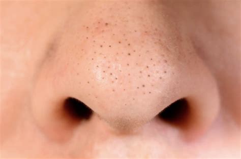 Pictures Of Blackheads On Black People