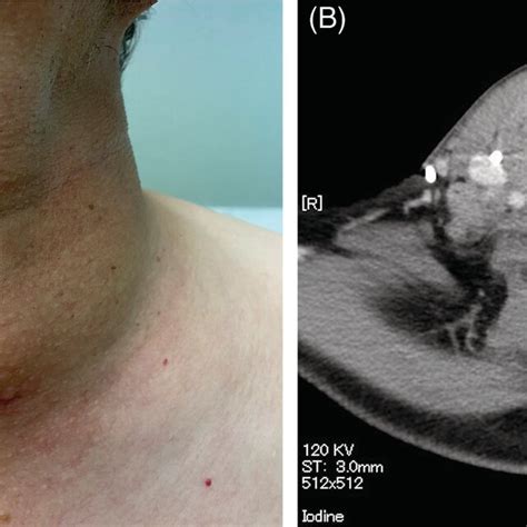 A Photography Of The Neck Shows Diffuse Goitre Enlargement B