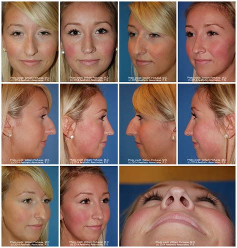 Narrow Nasal Bones Before And After Photo Gallery Nose Surgery Photos