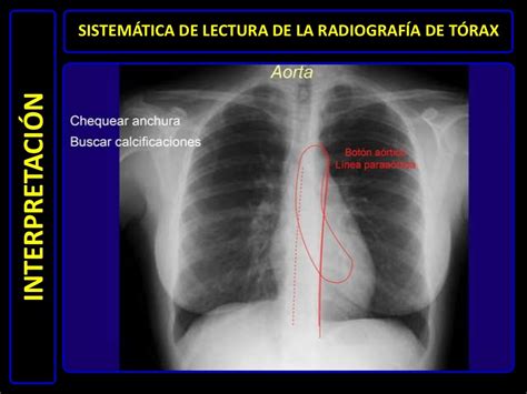 Diagnóstico por imágenes radiografía de tórax normal
