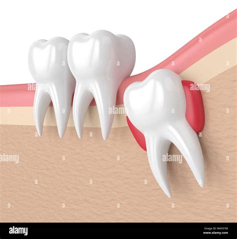 3d Render Of Teeth With Wisdom Cyst Concept Of Different Types Of