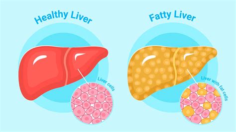 Fatty Liver Disease Expert Explains Risk Factors And Prevention Tips