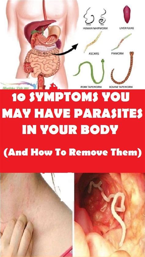 10 Symptoms You Have Parasites In Your Body And How To Remove Them Medicine Health Life