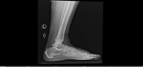 Minimally Invasive Mis Metatarsal Osteotomies — Chicago Foot And Ankle