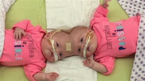 Conjoined Twins Undergo 11 Hour Long Surgery Before Birthday