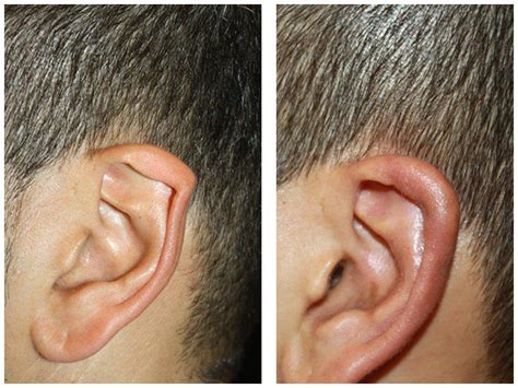 Pixie Ear Modification Extreme Diy Body Modifications Make Your Own Elf Ears Pointed Or