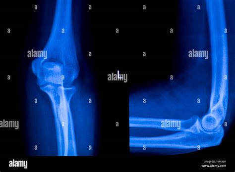 Forearm Arm And Elbow Injury Xray Scan Test Reults To Diagnose Pain