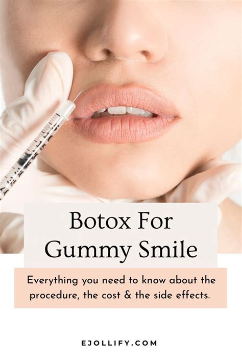 Botox For Gummy Smile The Complete Guide Gummy Smile Botox Gummy