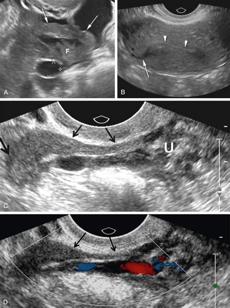Ultrasound Evaluation Of The Fallopian Tube Clinical Tree